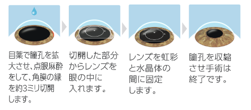 手術の概要